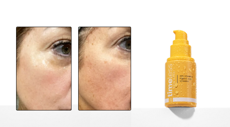 How Vitamin C Serum Can Help Your Hyperpigmentation – Timeless Skin Care